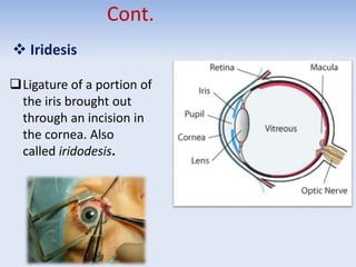 Cont.
 Iridesis
Ligature of a portion of
the iris brought out
through an incision in
the cornea. Also
called iridodesis.
 