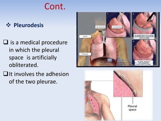 Cont.
 Pleurodesis
 is a medical procedure
in which the pleural
space is artificially
obliterated.
It involves the adhesion
of the two pleurae.
 