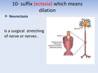 10- suffix (ectasia) which means
dilation
 Neurectasia
Is a surgical stretching
of nerve or nerves .
 