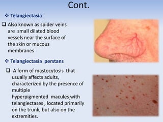 Cont.
 Telangiectasia
 Also known as spider veins
are small dilated blood
vessels near the surface of
the skin or mucous
membranes
 Telangiectasia perstans
 A form of mastocytosis that
usually affects adults,
characterized by the presence of
multiple
hyperpigmented macules with
telangiectases , located primarily
on the trunk, but also on the
extremities.
 