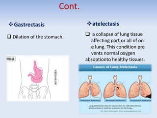 Cont.
Gastrectasis
 Dilation of the stomach.
atelectasis
 a collapse of lung tissue
affecting part or all of on
e lung. This condition pre
vents normal oxygen
absoptionto healthy tissues.
 