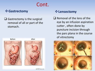 Cont.
Gastrectomy
 Gastrectomy is the surgical
removal of all or part of the
stomach.
Lensectomy
 Removal of the lens of the
eye by an infusion aspiration
cutter , often done by
puncture incision through
the pars plana in the course
of vitrectomy
 