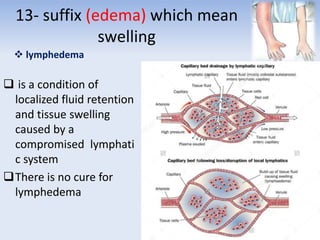 13- suffix (edema) which mean
swelling
 lymphedema
 is a condition of
localized fluid retention
and tissue swelling
caused by a
compromised lymphati
c system
There is no cure for
lymphedema
 