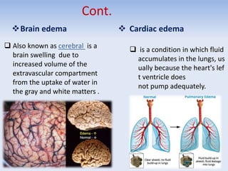 Cont.
Brain edema
 Also known as cerebral is a
brain swelling due to
increased volume of the
extravascular compartment
from the uptake of water in
the gray and white matters .
 Cardiac edema
 is a condition in which fluid
accumulates in the lungs, us
ually because the heart's lef
t ventricle does
not pump adequately.
 