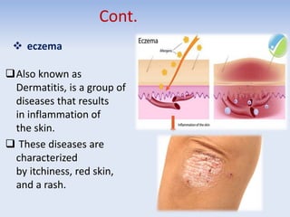 Cont.
 eczema
Also known as
Dermatitis, is a group of
diseases that results
in inflammation of
the skin.
 These diseases are
characterized
by itchiness, red skin,
and a rash.
 