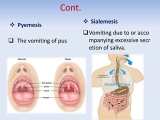 Cont.
 Pyemesis
 The vomiting of pus
 Sialemesis
Vomiting due to or acco
mpanying excessive secr
etion of saliva.
 
