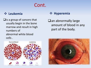 Cont.
 Leukemia  Hyperemia
an abnormally large
amount of blood in any
part of the body.
is a group of cancers that
usually begin in the bone
marrow and result in high
numbers of
abnormal white blood
cells .
 