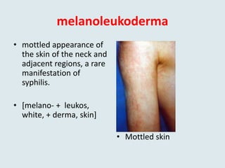 melanoleukoderma
• mottled appearance of
the skin of the neck and
adjacent regions, a rare
manifestation of
syphilis.
• [melano- + leukos,
white, + derma, skin]
• Mottled skin
 