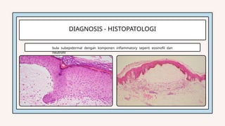 Comprehensive Overview of Bullous Pemphigoid: Pathophysiology ...