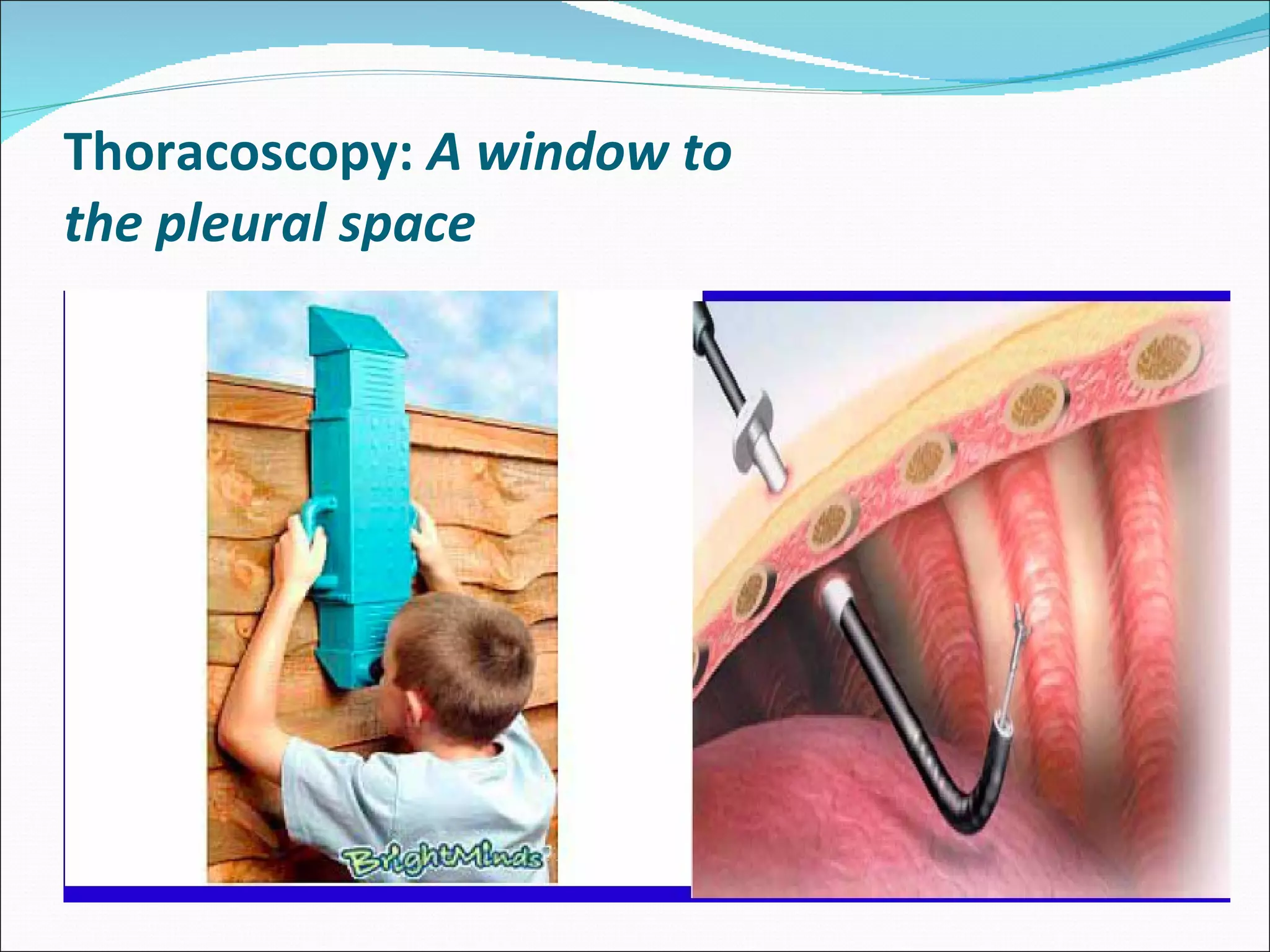 Toracoiscopia Medical Thoracoscopy | PPT