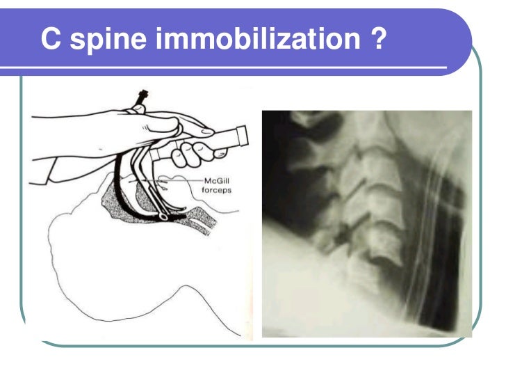 icd 10 imuscle sprain mid thoracic icd 10 imuscle sprain mid thoracic