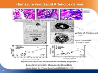 Harnsäure verursacht Arteriolosklerose
                                                                                                    Hyalinose




     Normouricämische Kontrolle               Hyperuricämische Ratte




                                  Kontrolle                            Kontrolle
                                                                                      Verdickte aff. Arteriolenwand
                           alpha-smooth-actin
                            Färbung verstärkt

                                                                                      Vimentin Färbung verstärkt
                                                                                       in Intralobular Arterien




             Hyperuriämie verursacht renale small-vessel disease, Allopurinol u.
                     Benzodiaron vermindern Blutdruck u.Gefäßwanddicke
                    Mazzali M et a l. Am J Physiol Renal Physiol 2002;282:F991-F997
16
 