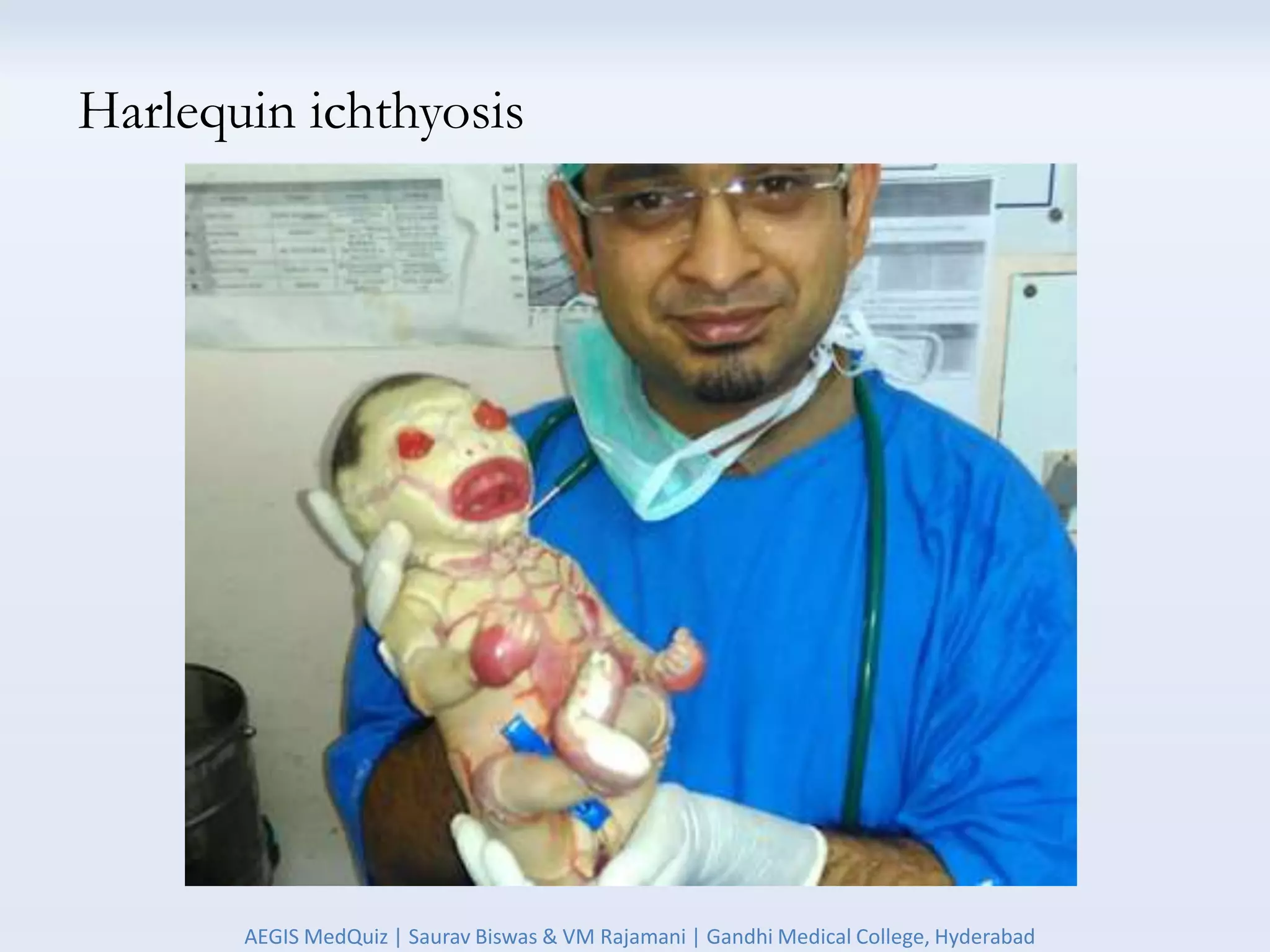 Harlequin ichthyosis
AEGIS MedQuiz | Saurav Biswas & VM Rajamani | Gandhi Medical College, Hyderabad
 