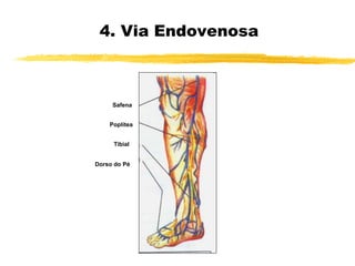 4. Via Endovenosa
Dorso do Pé
Tibial
Poplítea
Safena
 