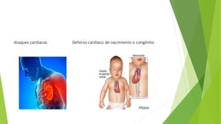 Ataques cardiacos Defecto cardiaco de nacimiento o congénito
 