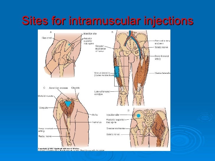 intramuscular injection sites