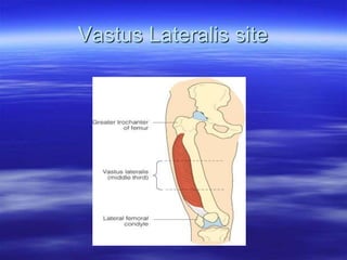 Vastus Lateralis site
 