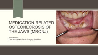 MEDICATION-RELATED
OSTEONECROSIS OF
THE JAWS (MRONJ)
Hadi Munib
Oral and Maxillofacial Surgery Resident
 