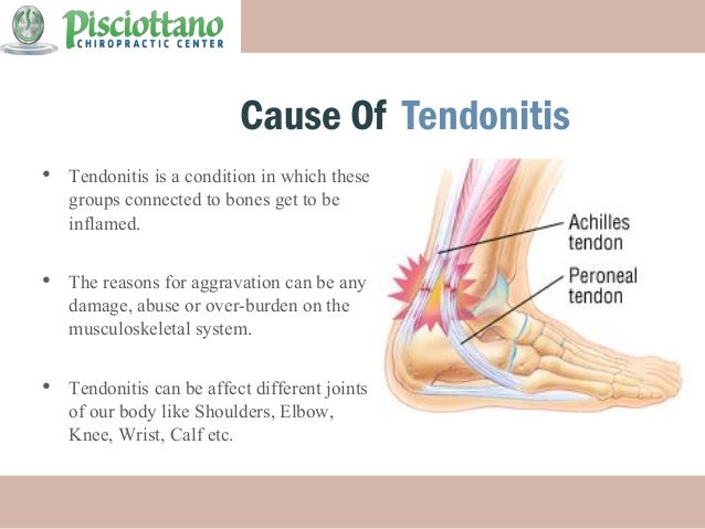 Medication Of Tendonitis - Treatment By Pisciottano Chiropractic Cent…
