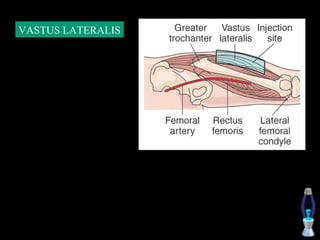 VASTUS LATERALIS
 