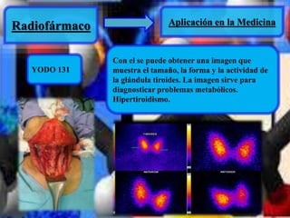 Radiofármaco Aplicación en la Medicina 
YODO 131 
Con el se puede obtener una imagen que 
muestra el tamaño, la forma y la actividad de 
la glándula tiroides. La imagen sirve para 
diagnosticar problemas metabólicos. 
Hipertiroidismo. 
 