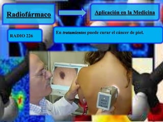 Radiofármaco Aplicación en la Medicina 
RADIO 226 
En tratamientos puede curar el cáncer de piel. 
 