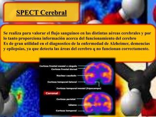 SPECT Cerebral 
Se realiza para valorar el flujo sanguíneo en las distintas aéreas cerebrales y por 
lo tanto proporciona información acerca del funcionamiento del cerebro 
Es de gran utilidad en el diagnostico de la enfermedad de Alzheimer, demencias 
y epilepsias, ya que detecta las áreas del cerebro q no funcionan correctamente. 
 