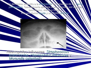 Se denomina  sinusitis  a la  inflamación  de la mucosa de los  senos   paranasales . Generalmente obedece a una infección por agentes bacterianos, virales u hongos. Hay una forma  aguda  y una forma  crónica .    Haemophilus influenzae    Streptococcus   pneumoniae ,  Haemophilus   influenzae  y  Moraxella   catarrhalis .  