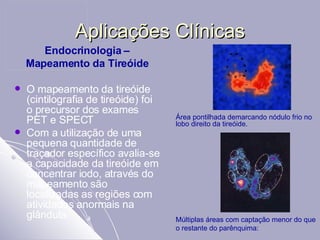 Aplicações Clínicas Endocrinologia –  Mapeamento da Tireóide O mapeamento da tireóide (cintilografia de tireóide) foi o precursor dos exames PET e SPECT Com a utilização de uma pequena quantidade de traçador específico avalia-se a capacidade da tireóide em concentrar iodo, através do mapeamento são localizadas as regiões com atividades anormais na glândula. Múltiplas áreas com captação menor do que o restante do parênquima: Área pontilhada demarcando nódulo frio no lobo direito da tireóide. 