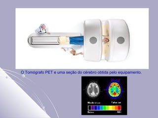 O Tomógrafo PET e uma seção do cérebro obtida pelo equipamento.                                                                                                                                                                                     
