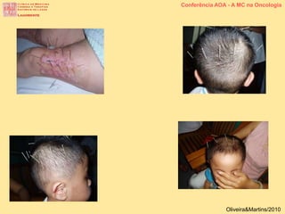 Conferência AOA - A MC na Oncologia
Oliveira&Martins/2010
 