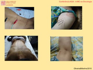 Conferência AOA - A MC na Oncologia
Oliveira&Martins/2010
 