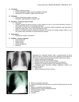 Arlindo Ugulino Netto – MEDICINA DE URG•NCIA – MEDICINA P8 – 2011.1
118
C. Circula‚ƒo
 Avaliar a silhueta card•aca
 Pneumomediastino: sugere ruptura de es•fago ou traqu‚ia
 Alargamento de mediastino: sugere ruptura de aorta
D. Diafragma
 C‰pula diafragmƒtica direita e esquerda
 Eleva†ˆes, pneumoperit•nio e v•sceras ocas
E. Esqueleto - arcabou‚o Šsseo do tŠrax
 Clav•culas
 Costelas: quando hƒ fratura de duas ou mais costelas em dois ou mais focos diferentes, promove o
t„rax instƒvel (flail chest), com respira†…o paradoxal.
 Escƒpulas: sua les…o com comprometimento das 3 primeiras costelas geralmente estƒ associada a
les…o de grandes vasos, como ruptura traumƒtica de aorta.
 Esterno: as lesˆes de esterno geralmente decorrem de traumas com grande energia cin‚tica e, por
isso, podem estar associadas ao comprometimento card•aco.
F. Partes Moles
 Pesquisa por enfisema subcut‡neo
G. Artefatos – drenos e cateteres
 Tubo Orotraqueal
 Dreno torƒcico
 Cateter venoso
 Sonda nasogƒstrica
 Eletrodos
Radiografia em inspira†…o for†ada. Notar o posicionamento do dreno
(seta azul clara) e a pequena zona e pouco definida de pneumotorax do
lado direito no v‚rtice do pulm…o (seta vermelha). Desta forma, temos:
A – traqu‚ia relativamente centralizada
B – Presen†a de discreto pneumot„rax Œ direita
C – Silhueta card•aca normal, sem alargamento do mediastino
D – Diafragma em posi†…o anat•mica, sem altera†ˆes de trauma
E – Arcabou†o „sseo: clav•culas, costelas, escƒpulas e esterno com
aus€ncia de fraturas.
F – Partes moles
G – Nota-se a presen†a de dreno torƒcico.
A – Desvio da traqu‚ia Œ esquerda
B – Grande pneumot„rax do lado direito e provƒvel contus…o pulmonar do lado
esquerdo
C – Desvio do mediastino para esquerda.
D – Rebaixamento de c‰pula diafragmƒtica direita.
E – Arcabou†o •sseo normal
F – Sem altera†ˆes
G – Ausente
 