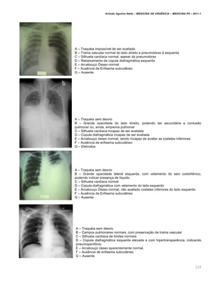 Arlindo Ugulino Netto – MEDICINA DE URG•NCIA – MEDICINA P8 – 2011.1
119
A – Traqu‚ia imposs•vel de ser avaliada
B – Trama vascular normal do lado direito e pneumot„rax Œ esquerda
C – Silhueta card•aca normal, apesar do pneumot„rax
D – Rebaixamento de c‰pula diafragmƒtica esquerda
E – Arcabou†o •sseo normal
F – Aus€ncia de Enfisema subcut‡neo
G – Ausente
A – Traqu‚ia sem desvio
B – Grande opacidade do lado direito, podendo ser secundƒria a contus…o
pulmonar ou, ainda, empiema pulmonar
C – Silhueta card•aca incapaz de ser avaliada
D – C‰pula diafragmƒtica incapaz de ser avaliada
E – Arcabou†o „sseo normal, sendo incapaz de avaliar as costelas inferiores
F – Aus€ncia de enfisema subcut‡neo
G – Eletrodos
A – Traqu‚ia sem desvio
B – Grande opacidade lateral esquerda, com velamento do seio costofr€nico,
podendo indicar presen†a de l•quido.
C – Silhueta card•aca normal
D – C‰pula diafragmƒtica com velamento do lado esquerdo
E – Arcabou†o •sseo normal, n…o avaliado costelas inferiores do lado esquerdo
F – Aus€ncia de Enfisema subcut‡neo
G – Ausente
A – Traqu‚ia sem desvio
B – Campos pulmonares normais, com preserva†…o de trama vascular
C – Silhueta card•aca de limites normais
D – C‰pula diafragmƒtica esquerda elevada e com hipertranspar€ncia, indicando
pneumoperit•nio.
E – Arcabou†o „sseo aparentemente normal.
F – Aus€ncia de enfisema subcut‡neo
G – Ausente
 