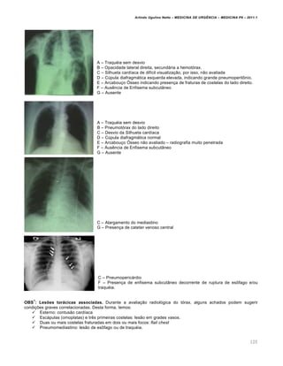 Arlindo Ugulino Netto – MEDICINA DE URG•NCIA – MEDICINA P8 – 2011.1
120
A – Traqu‚ia sem desvio
B – Opacidade lateral direita, secundƒria a hemot„rax.
C – Silhueta card•aca de dif•cil visualiza†…o, por isso, n…o avaliada
D – C‰pula diafragmƒtica esquerda elevada, indicando grande pneumoperit•nio.
E – Arcabou†o •sseo indicando presen†a de fraturas de costelas do lado direito.
F – Aus€ncia de Enfisema subcut‡neo
G – Ausente
A – Traqu‚ia sem desvio
B – Pneumot„rax do lado direito
C – Desvio da Silhueta card•aca
D – C‰pula diafragmƒtica normal
E – Arcabou†o •sseo n…o avaliado – radiografia muito penetrada
F – Aus€ncia de Enfisema subcut‡neo
G – Ausente
C – Alargamento do mediastino
G – Presen†a de cateter venoso central
C – Pneumopericƒrdio
F – Presen†a de enfisema subcut‡neo decorrente de ruptura de es•fago e/ou
traqu‚ia.
OBS
1
: Lesões torácicas associadas. Durante a avalia†…o radiol„gica do t„rax, alguns achados podem sugerir
condi†ˆes graves correlacionadas. Desta forma, temos:
 Esterno: contus…o card•aca
 Escƒpulas (omoplatas) e tr€s primeiras costelas: les…o em grades vasos.
 Duas ou mais costelas fraturadas em dois ou mais focos: flail chest
 Pneumomediastino: les…o de es•fago ou de traqu‚ia.
 