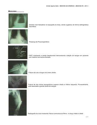 Arlindo Ugulino Netto – MEDICINA DE URG•NCIA – MEDICINA P8 – 2011.1
123
MISCELˆNEA
Grande nível hidroaéreo na topografia do tórax, sendo sugestivo de hérnia diafragmática
traumática.
Presença de Pneumoperitônio
FAST mostrando a janela hepatorrenal demonstrando coleção de sangue em paciente
com histórico de trauma fechado.
Fratura de colo cirúrgico de úmero direito.
Fratura de dos ramos isquiopúbicos superior direito e inferior esquerdo. Provavelmente,
está associada a grande perda de sangue.
Radiografia da coxa mostrando fratura cominutiva do fêmur, no terço médio e distal.
 