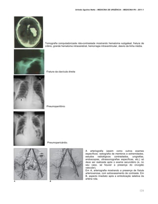 Arlindo Ugulino Netto – MEDICINA DE URG•NCIA – MEDICINA P8 – 2011.1
124
Tomografia computadorizada não-contrastada mostrando hematoma subgaleal, fratura de
crânio, grande hematoma intracerebral, hemorragia intraventricular, desvio da linha média.
Fratura da clavícula direita
Pneumoperitônio
Pneumopericárdio.
A arteriografia (assim como outros exames
específicos: radiografia de membros e extremidades,
estudos radiológicos contrastados, urografias,
endoscopias, ultrassonografias específicas, etc.) só
deve ser realizada após o exame secundário (e, no
seu caso, se houver a presença do cirurgião
vascular).
Em A, arteriografia mostrando a presença de fístula
arteriovenosa, com extravasamento de contraste. Em
B, aspecto imediato após a embolização seletiva da
artéria rota.
 