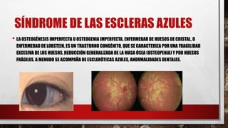 SÍNDROME DE LAS ESCLERAS AZULES
• LA OSTEOGÉNESIS IMPERFECTA U OSTEOGENIA IMPERFECTA, ENFERMEDAD DE HUESOS DE CRISTAL, O
ENFERMEDAD DE LOBSTEIN, ES UN TRASTORNO CONGÉNITO, QUE SE CARACTERIZA POR UNA FRAGILIDAD
EXCESIVA DE LOS HUESOS, REDUCCIÓN GENERALIZADA DE LA MASA ÓSEA (OSTEOPENIA) Y POR HUESOS
FRÁGILES. A MENUDO SE ACOMPAÑA DE ESCLERÓTICAS AZULES, ANORMALIDADES DENTALES.
 