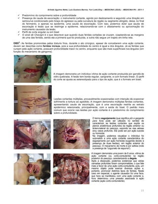 Arlindo Ugulino Netto; Luiz Gustavo Barros; Yuri Leite Eloy – MEDICINA LEGAL – MEDICINA P8 – 2011.1
15
 Predom•nio do comprimento sobre a profundidade
 Presen‚a de cauda de escoria‚„o: o instrumento cortante, agindo por deslizamento e seguindo uma dire‚„o em
semicurva condicionado pelo bra‚o do agressor ou pela curvatura da regi„o ou segmento atingido, deixa, no final
do ferimento, e apenas na epiderme, uma cauda de escoria‚„o. Com isso, podemos dizer que cauda de
escoria‚„o € les„o que se restringe a epiderme, relacionando-se com o afastamento ou aproxima‚„o do
instrumento causador da les„o.
 Perfil de corte angular ou em bisel
 O sinal de Chavigni € o que descreve que quando duas feridas cortadas se cruzam, coaptando-se as margens
de uma das feridas, sendo ela a primeira que foi produzida, a outra n„o segue um trajeto em linha reta.
OBS
4
: As feridas promovidas pelos bisturis frios, durante o ato cir‹rgico, apesar de conceberem uma a‚„o cortante,
devem ser descritas como feridas incisas, pois a sua profundidade do centro € igual a dos Žngulos. Jˆ as feridas que
cursam pela a‚„o cortante, possuem profundidade maior no centro, enquanto que s„o mais superficiais nos Žngulos (em
fun‚„o do mecanismo de gangorra).
A imagem demonstra um individuo v•tima de a‚„o cortante produzida por garrafa de
vidro quebrada. A les„o tem borda regular, sangrante, e com formato linear. O perfil
do corte se ajusta ao estereotipado para o tipo de a‚„o, que € o formato em bisel.
Les‡es cortantes m‹ltiplas, provavelmente ocasionadas com inten‚„o de ocasionar
sofrimento e tortura ao agredido. A imagem demonstra m‹ltiplas feridas cortantes,
apresentando cauda de escoria‚„o, que € uma escoria‚„o restrita ao estrato
epid€rmico relacionada, principalmente, com a sa•da do bisel. O padr„o mais
comum que ocorre nas les‡es por a‚„o cortante € o predom•nio do comprimento
sobre a profundidade.
O termo esgorjamento (que significa pôr a garganta
para fora) pode ser utilizado no sentido de
caracterizar as les‡es cortantes que exp‡e os
planos anat•micos profundos da regi„o anterior ou
Žntero-lateral do pesco‚o, expondo as vias a€reas
e/ou vasos profundo. Ele pode ser por a‚„o suicida
ou homicida.
Na imagem, podemos visualizar o indiv•duo foi
submetido a uma a‚„o cortante caracter•stica do
esgorjamento por a‚„o homicida (sugerida devido †
presen‚a de duas les‡es), em regi„o anterior do
pesco‚o. O mecanismo de morte € por asfixia (note
a presen‚a de “cogumelo de espuma”).
A imagem demonstra uma jovem de 8 anos, v•tima de
a‚„o cortante (ou corto-contudente) na regi„o
posterior do pesco‚o, caracterizando a degola.
Apƒs a dissec‚„o, podemos evidenciar que vˆrias
camadas profundas foram comprometidas, o que fala
mais a favor de uma a‚„o corto-contudente, pois, um
mesmo objeto pode exercer diversas a‚‡es e,
portanto, promover distintos tipos de feridas. Neste
caso em especial, o agente causador foi uma faca,
que hora se manifestou com uma a‚„o cortante e,
hora determinou uma press„o associada † a‚„o
cortante (a‚„o corto-contundente).
 