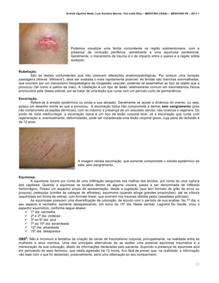 Arlindo Ugulino Netto; Luiz Gustavo Barros; Yuri Leite Eloy – MEDICINA LEGAL – MEDICINA P8 – 2011.1
17
Podemos visualizar uma ferida contundente na região submentoniana, com a
presença de contusão periférica, semelhante a uma equimose perilesional.
Geralmente, o mecanismo de trauma é o de impacto entre o queixo e a região sólida
qualquer.
Rubefação.
São as lesões contundentes que não possuem alterações anatomopatológicas. Por possuir uma duração
passageira (leia-se “ef‰mera”), deve ser avaliada o mais rapidamente possível. As feridas são manchas avermelhadas,
que ocorrem por um mecanismo fisiopatológico de congestão vascular, podendo se assemelhar ao tipo de objeto que a
provocou (tal como a palma da mão). A rubefação é um tipo de lesão relativamente comum em traumatismos físicos
promovidos pela classe policial, por se tratar de uma lesão que cursa com um período curto de permanência.
Escoriação.
Refere-se à erosão epidérmica ou ainda a sua abrasão. Geralmente se ajusta a dinâmica do evento, ou seja,
possui um desenho símile ao que a provocou. A escoriação típica não compromete a derme, sem sangramento (pois
não compromete as papilas dérmicas), com no máximo a presença de um exsudato seroso, não cicatriza e regenera. Do
ponto de vista médico-legal, a escoriação típica é um tipo de lesão corporal leve. Já a escoriação que curse com
regeneração e, eventualmente, deformidades, pode ser considerada uma lesão corporal grave, cuja pena de reclusão é
de 12 anos.
A imagem retrata escoriação, que somente compromete o estrato epidérmico da
pele, sem sangramento.
Equimose.
A equimose ocorre por conta de uma infiltração sanguínea nas malhas dos tecidos, por conta de uma ruptura
dos capilares. Quando a equimose se localiza dentro de alguma víscera, passa a ser denominada de infiltrado
hemorrágico. Possui um espectro amplo de apresentação, desde a sugilaƒ„o (que tem formato de grão de arroz ou
púrpura), pet…quias (símiles às cabeças de alfinetes), equimoma (quando atinge grandes proporções), até as v•bices
(equimoses em forma de estrias, com formato linear, que ocorrem nos traumas obtidos pelos cassetetes policiais).
As equimoses possuem uma diversificação de coloração, de acordo com o período de sua análise. No 1º dia, o
seu aspecto é vermelho, somente desaparecendo, em torno do 15º dia. Neste sentido, Legrand Du Saulle, criou o
espectro equimótico, conforme segue abaixo:
 1º dia: vermelha
 2º e 3º dia: violácea
 3º ao 6º dia: azul
 7º ao 10º dia: esverdeada
 12º dia: amarelada
 15º dia: desaparece
OBS
6
: Não é incomum a tentativa de criação de cenas de traumatismo corporal, principalmente, na realidade entre as
mulheres e seus maridos. Uma das principais alternativas de se avaliar uma possível equimose traumática é a
mensuração de sua coloração, aliado às informações declaradas pelo paciente. Supondo a presença de equimose azul
em periciando do sexo feminino, que relata agressão há 12 horas, fica fácil de prever que, na realidade, a informação
não bate com o que foi declarado, possivelmente, seria uma difamação ao seu companheiro.
 