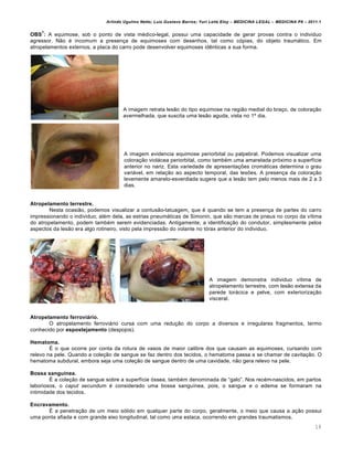 Arlindo Ugulino Netto; Luiz Gustavo Barros; Yuri Leite Eloy – MEDICINA LEGAL – MEDICINA P8 – 2011.1
18
OBS
7
: A equimose, sob o ponto de vista m€dico-legal, possui uma capacidade de gerar provas contra o individuo
agressor. N„o € incomum a presen‚a de equimoses com desenhos, tal como cƒpias, do objeto traumˆtico. Em
atropelamentos externos, a placa do carro pode desenvolver equimoses id…nticas a sua forma.
A imagem retrata les„o do tipo equimose na regi„o medial do bra‚o, de colora‚„o
avermelhada, que suscita uma les„o aguda, vista no 1• dia.
A imagem evidencia equimose periorbital ou palpebral. Podemos visualizar uma
colora‚„o violˆcea periorbital, como tamb€m uma amarelada prƒximo a superf•cie
anterior no nariz. Esta variedade de apresenta‚‡es cromˆticas determina o grau
variˆvel, em rela‚„o ao aspecto temporal, das les‡es. A presen‚a da colora‚„o
levemente amarelo-esverdiada sugere que a les„o tem pelo menos mais de 2 a 3
dias.
Atropelamento terrestre.
Nesta ocasi„o, podemos visualizar a contus„o-tatuagem, que € quando se tem a presen‚a de partes do carro
impressionando o individuo; al€m dela, as estrias pneumˆticas de Simonin, que s„o marcas de pneus no corpo da v•tima
do atropelamento, podem tamb€m serem evidenciadas. Antigamente, a identifica‚„o do condutor, simplesmente pelos
aspectos da les„o era algo rotineiro, visto pela impress„o do volante no tƒrax anterior do individuo.
A imagem demonstra individuo v•tima de
atropelamento terrestre, com les„o extensa da
parede torˆcica e pelve, com exterioriza‚„o
visceral.
Atropelamento ferroviário.
O atropelamento ferroviˆrio cursa com uma redu‚„o do corpo a diversos e irregulares fragmentos, termo
conhecido por espostejamento (despojos).
Hematoma.
• o que ocorre por conta da rotura de vasos de maior calibre dos que causam as equimoses, cursando com
relevo na pele. Quando a cole‚„o de sangue se faz dentro dos tecidos, o hematoma passa a se chamar de cavita‚„o. O
hematoma subdural, embora seja uma cole‚„o de sangue dentro de uma cavidade, n„o gera relevo na pele.
Bossa sanguínea.
• a cole‚„o de sangue sobre a superf•cie ƒssea, tamb€m denominada de “galo”. Nos rec€m-nascidos, em partos
laboriosos, o caput secundum € considerado uma bossa sangu•nea, pois, o sangue e o edema se formaram na
intimidade dos tecidos.
Encravamento.
• a penetra‚„o de um meio sƒlido em qualquer parte do corpo, geralmente, o meio que causa a a‚„o possui
uma ponta afiada e com grande eixo longitudinal, tal como uma estaca, ocorrendo em grandes traumatismos.
 