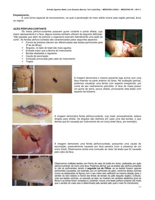 Arlindo Ugulino Netto; Luiz Gustavo Barros; Yuri Leite Eloy – MEDICINA LEGAL – MEDICINA P8 – 2011.1
19
Empalamento.
• uma forma especial de encravamento, na qual a penetra‚„o do meio sƒlido ocorre pela regi„o perineal, Žnus
ou vagina.
AÇÃO PÉRFURO-CORTANTE
Os meios p€rfuro-cortantes possuem gume cortante e ponta afiada, cujo
maior representante € a faca. Alguns autores tamb€m utilizam da seguinte defini‚„o:
“S„o aqueles que al€m de perfurar o organismo exercem lateralmente uma a‚„o de
corte”. As feridas p€rfuro-cortadas s„o caracterizadas pelos seguintes aspectos:
 Forma de botoeira (devem ser diferenciadas das les‡es perfurantes pela
2‘ lei de filhos)
 ’ngulos, no lado do bisel s„o mais agudos.
 Entrada maior que a lŽmina do instrumento
 Bordas afastadas e regulares
 Cauda de escoria‚„o
 Contus„o provocada pelo cabo do instrumento
 Trajeto
A imagem demonstra o mesmo paciente logo acima com uma
faca inserida na parte anterior do tƒrax. Na avalia‚„o pericial,
podemos visualizar uma ferida com aspecto enegrecido, por
conta de seu resfriamento pƒs-ƒbito. A faca de mesa possui
um gume de serra, pouco afiada, provocando esta les„o com
aspecto de botoeira.
A imagem demonstra ferida p€rfuro-cortante, cujo bisel, provavelmente, estava
dirigido para direita. Os Žngulos s„o distintos em cada uma das bordas, o que
denota que foi causada por instrumento de um ‹nico bisel (faca, por exemplo).
A imagem demonstra uma ferida p€rfuro-cortada, possuindo uma cauda de
escoria‚„o, possivelmente causada por faca peixeira (com a presen‚a de um
‹nico bisel). Observamos ainda uma contus„o ao redor da les„o que foi causada
pelo cabo da faca.
Observamos m‹ltiplas les‡es com forma de casa de bot„o em dorso, realizadas por a‚„o
p€rfuro-cortante, tal como uma faca. Podemos afirmar que as les‡es s„o p€rfuro-cortantes
(e n„o sƒ perfurantes) devido † segunda Lei de Filhos: se as les‡es fossem apenas
perfurantes (causadas, por exemplo, por um perfurador de gelo), ver•amos les‡es vizinhas
(como as destacadas na figura) com o seu maior eixo retificado na mesma dire‚„o (pois o
sentido do eixo estaria a merc… das linhas de tens„o da pele daquela regi„o). Contudo,
note que les‡es vizinhas, no exemplo ao lado, se mostram em sentidos aleatƒrios (pois as
fibras e as linhas foram cortadas) e, portando, houve uma les„o p€rfuro-cortante (de modo
que o sentido do maior eixo € determinado pelo sentido pelo qual o meio foi introduzido).
 