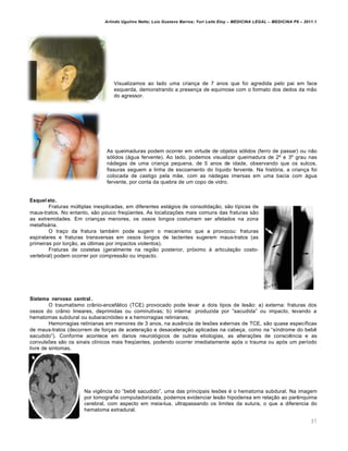 Arlindo Ugulino Netto; Luiz Gustavo Barros; Yuri Leite Eloy – MEDICINA LEGAL – MEDICINA P8 – 2011.1
37
Visualizamos ao lado uma crian‚a de 7 anos que foi agredida pelo pai em face
esquerda, demonstrando a presen‚a de equimose com o formato dos dedos da m„o
do agressor.
As queimaduras podem ocorrer em virtude de objetos sƒlidos (ferro de passar) ou n„o
sƒlidos (ˆgua fervente). Ao lado, podemos visualizar queimadura de 2• e 3• grau nas
nˆdegas de uma crian‚a pequena, de 5 anos de idade, observando que os sulcos,
fissuras seguem a linha de escoamento do l•quido fervente. Na histƒria, a crian‚a foi
colocada de castigo pela m„e, com as nˆdegas imersas em uma bacia com ˆgua
fervente, por conta da quebra de um copo de vidro.
Esquel eto.
Fraturas m‹ltiplas inexplicadas, em diferentes estˆgios de consolida‚„o, s„o t•picas de
maus-tratos. No entanto, s„o pouco freq“entes. As localiza‚‡es mais comuns das fraturas s„o
as extremidades. Em crian‚as menores, os ossos longos costumam ser afetados na zona
metafisˆria.
O tra‚o da fratura tamb€m pode sugerir o mecanismo que a provocou: fraturas
espiralares e fraturas transversas em ossos longos de lactentes sugerem maus-tratos (as
primeiras por tor‚„o, as ‹ltimas por impactos violentos).
Fraturas de costelas (geralmente na regi„o posterior, prƒximo † articula‚„o costo-
vertebral) podem ocorrer por compress„o ou impacto.
Sistema nervoso central .
O traumatismo crŽnio-encefˆlico (TCE) provocado pode levar a dois tipos de les„o: a) externa: fraturas dos
ossos do crŽnio lineares, deprimidas ou cominutivas; b) interna: produzida por “sacudida” ou impacto, levando a
hematomas subdural ou subaracnƒideo e a hemorragias retinianas;
Hemorragias retinianas em menores de 3 anos, na aus…ncia de les‡es externas de TCE, s„o quase espec•ficas
de maus-tratos (decorrem de for‚as de acelera‚„o e desacelera‚„o aplicadas na cabe‚a, como na “s•ndrome do beb…
sacudido”). Conforme acontece em danos neurolƒgicos de outras etiologias, as altera‚‡es de consci…ncia e as
convuls‡es s„o os sinais cl•nicos mais freq“entes, podendo ocorrer imediatamente apƒs o trauma ou apƒs um per•odo
livre de sintomas.
Na vig…ncia do “beb… sacudido”, uma das principais les‡es € o hematoma subdural. Na imagem
por tomografia computadorizada, podemos evidenciar les„o hipodensa em rela‚„o ao par…nquima
cerebral, com aspecto em meia-lua, ultrapassando os limites da sutura, o que a diferencia do
hematoma extradural.
 