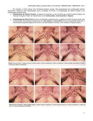 Arlindo Ugulino Netto; Luiz Gustavo Barros; Yuri Leite Eloy – MEDICINA LEGAL – MEDICINA P8 – 2011.1
53
De antemão, o hímen possui uma morfologia bastante variada, não apresentando uma configuração padrão.
Atualmente, utilizamos duas classificações para a avaliação do hímen: (1) classificação de Afrânio Peixoto e (2)
classificação de Oscar freire.
 Classificação de Afrânio Peixoto: se baseia na presença ou não de linhas de junção formando ângulos na
inserção da vagina. Podem ser classificados como comissurados, acomissurados e atípicos.
 Classificação de Oscar Freire: leva em consideração a presença e/ou o aspecto do orifício himenal, sendo esta
a classificação mais utilizada. Classifica-se em: sem orifício ou com orifício (uma vez enquadrada neste tipo, a
nomenclatura específica depende da forma ou da quantidade de orifícios, como mostram as figuras abaixo).
 