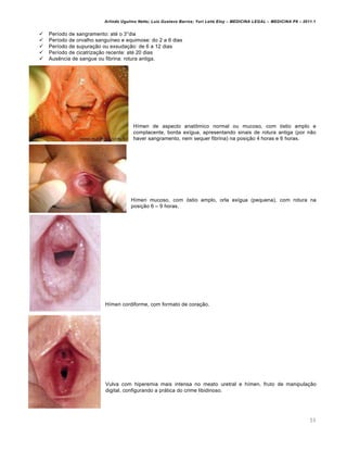 Arlindo Ugulino Netto; Luiz Gustavo Barros; Yuri Leite Eloy – MEDICINA LEGAL – MEDICINA P8 – 2011.1
55
 Per•odo de sangramento: at€ o 3šdia
 Per•odo de orvalho sangu•neo e equimose: do 2 a 6 dias
 Per•odo de supura‚„o ou exsuda‚„o: de 6 a 12 dias
 Per•odo de cicatriza‚„o recente: at€ 20 dias
 Aus…ncia de sangue ou fibrina: rotura antiga.
H•men de aspecto anat•mico normal ou mucoso, com ƒstio amplo e
complacente, borda ex•gua, apresentando sinais de rotura antiga (por n„o
haver sangramento, nem sequer fibrina) na posi‚„o 4 horas e 6 horas.
H•men mucoso, com ƒstio amplo, orla ex•gua (pequena), com rotura na
posi‚„o 6 – 9 horas.
H•men cordiforme, com formato de cora‚„o.
Vulva com hiperemia mais intensa no meato uretral e h•men, fruto de manipula‚„o
digital, configurando a prˆtica do crime libidinoso.
 