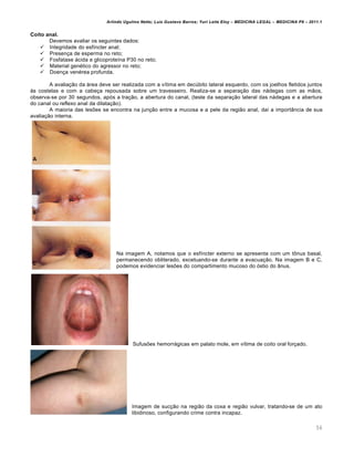 Arlindo Ugulino Netto; Luiz Gustavo Barros; Yuri Leite Eloy – MEDICINA LEGAL – MEDICINA P8 – 2011.1
56
Coito anal.
Devemos avaliar os seguintes dados:
 Integridade do esfíncter anal;
 Presença de esperma no reto;
 Fosfatase ácida e glicoproteína P30 no reto;
 Material genético do agressor no reto;
 Doença venérea profunda.
A avaliação da área deve ser realizada com a vítima em decúbito lateral esquerdo, com os joelhos fletidos juntos
às costelas e com a cabeça repousada sobre um travesseiro. Realiza-se a separação das nádegas com as mãos,
observa-se por 30 segundos, após a tração, a abertura do canal, (teste da separação lateral das nádegas e a abertura
do canal ou reflexo anal da dilatação).
A maioria das lesões se encontra na junção entre a mucosa e a pele da região anal, daí a importância de sua
avaliação interna.
Na imagem A, notamos que o esfíncter externo se apresenta com um tônus basal,
permanecendo obliterado, excetuando-se durante a evacuação. Na imagem B e C,
podemos evidenciar lesões do compartimento mucoso do óstio do ânus.
Sufusões hemorrágicas em palato mole, em vítima de coito oral forçado.
Imagem de sucção na região da coxa e região vulvar, tratando-se de um ato
libidinoso, configurando crime contra incapaz.
 