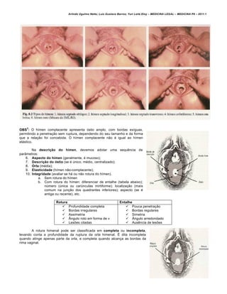 Arlindo Ugulino Netto; Luiz Gustavo Barros; Yuri Leite Eloy – MEDICINA LEGAL – MEDICINA P8 – 2011.1
60
OBS
2
: O hímen complacente apresenta óstio amplo, com bordas exíguas,
permitindo a penetração sem ruptura, dependendo do seu tamanho e da forma
que a relação foi concebida. O hímen complacente não é igual ao hímen
elástico.
Na descrição do hímen, devemos adotar uma sequência de
parâmetros:
6. Aspecto do hímen (geralmente, é mucoso);
7. Descrição do óstio (se é único, médio, centralizado);
8. Orla (média);
9. Elasticidade (hímen não-complacente);
10. Integridade (avaliar se há ou não rotura do hímen).
a. Sem rotura do hímen
b. Com rotura do hímen: diferenciar de entalhe (tabela abaixo);
número (única ou carúnculas mirtiforme); localização (mais
comum na junção dos quadrantes inferiores); aspecto (se é
antiga ou recente), etc.
Rotura Entalhe
 Profundidade completa
 Bordas irregulares
 Assimetria
 Ângulo roto em forma de v
 Lesões citadas
 Pouca penetração
 Bordas regulares
 Simetria
 Ângulo arredondado
 Ausência de lesões
A rotura himenal pode ser classificada em completa ou incompleta,
levando conta a profundidade da ruptura da orla himenal. É dita incompleta
quando atinge apenas parte da orla, e completa quando alcança as bordas da
rima vaginal.
 