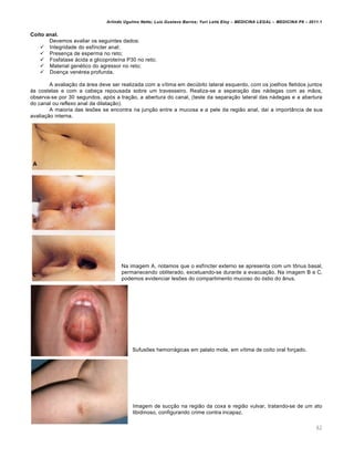Arlindo Ugulino Netto; Luiz Gustavo Barros; Yuri Leite Eloy – MEDICINA LEGAL – MEDICINA P8 – 2011.1
62
Coito anal.
Devemos avaliar os seguintes dados:
 Integridade do esfíncter anal;
 Presença de esperma no reto;
 Fosfatase ácida e glicoproteína P30 no reto;
 Material genético do agressor no reto;
 Doença venérea profunda.
A avaliação da área deve ser realizada com a vítima em decúbito lateral esquerdo, com os joelhos fletidos juntos
às costelas e com a cabeça repousada sobre um travesseiro. Realiza-se a separação das nádegas com as mãos,
observa-se por 30 segundos, após a tração, a abertura do canal, (teste da separação lateral das nádegas e a abertura
do canal ou reflexo anal da dilatação).
A maioria das lesões se encontra na junção entre a mucosa e a pele da região anal, daí a importância de sua
avaliação interna.
Na imagem A, notamos que o esfíncter externo se apresenta com um tônus basal,
permanecendo obliterado, excetuando-se durante a evacuação. Na imagem B e C,
podemos evidenciar lesões do compartimento mucoso do óstio do ânus.
Sufusões hemorrágicas em palato mole, em vítima de coito oral forçado.
Imagem de sucção na região da coxa e região vulvar, tratando-se de um ato
libidinoso, configurando crime contra incapaz.
 