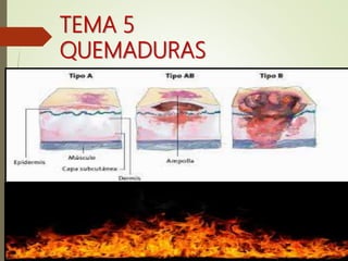 TEMA 5
QUEMADURAS
 