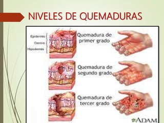 NIVELES DE QUEMADURAS
 